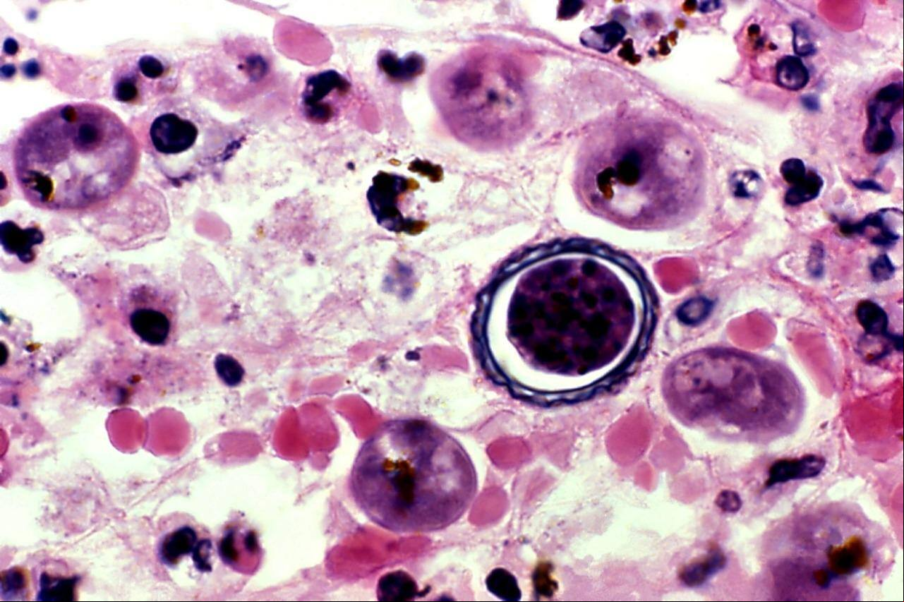 Infecção pela ameba Naegleria fowleri pode provocar morte